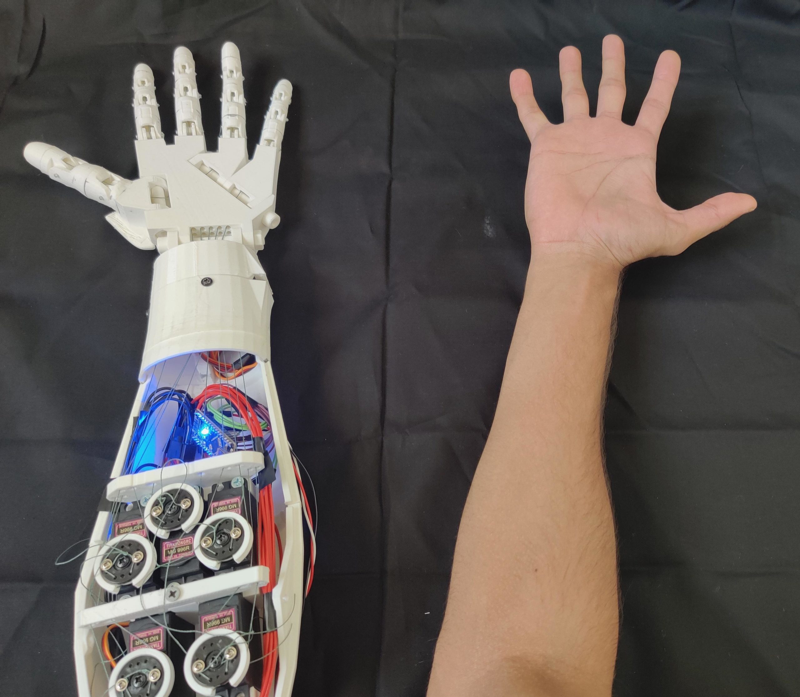 Designing a 3D-printed EMG bionic hand as a low-cost alternative